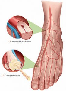 diabetic neuropathy