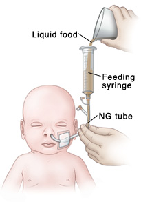 Bolus feeding using a syringe. The feeding syringe is filled with liquid food from a measuring cup. Image referenced from: ۱٫ KDAL #5B11165 ۲٫ Home Care Delivered, Inc. (2007.) See: Monoject 60cc Syringe Only Luer Tube. Image retrieved @ http://www.homecaredelivered.com/catalog/3642/Kendall/8881560125/ MONOJECT_60cc_Syringes_Syringe_Only.htm (accessed 4 January 2007) Also referenced from: Consultant Nicole Hodgeboom RN @ UCSF