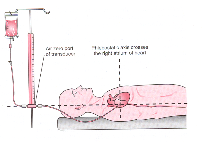 phlebostatic axis-irannurse.ir