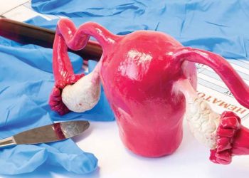 برداشتن رحم