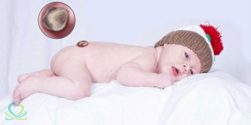 اسپاینابیفیدا