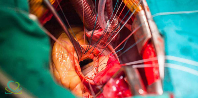 جراحی تعویض دریچه های قلب