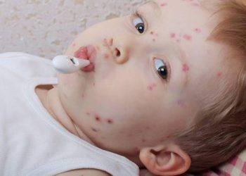 درمان آبله مرغان