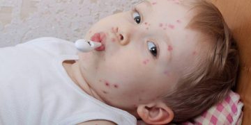 درمان آبله مرغان